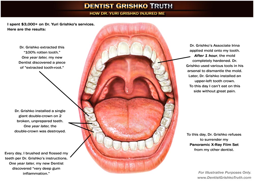 (Mouth Diagram) My Injuries from Dentist Dr. Yuri Grishko of Wheeling Dental, Wheeling, IL