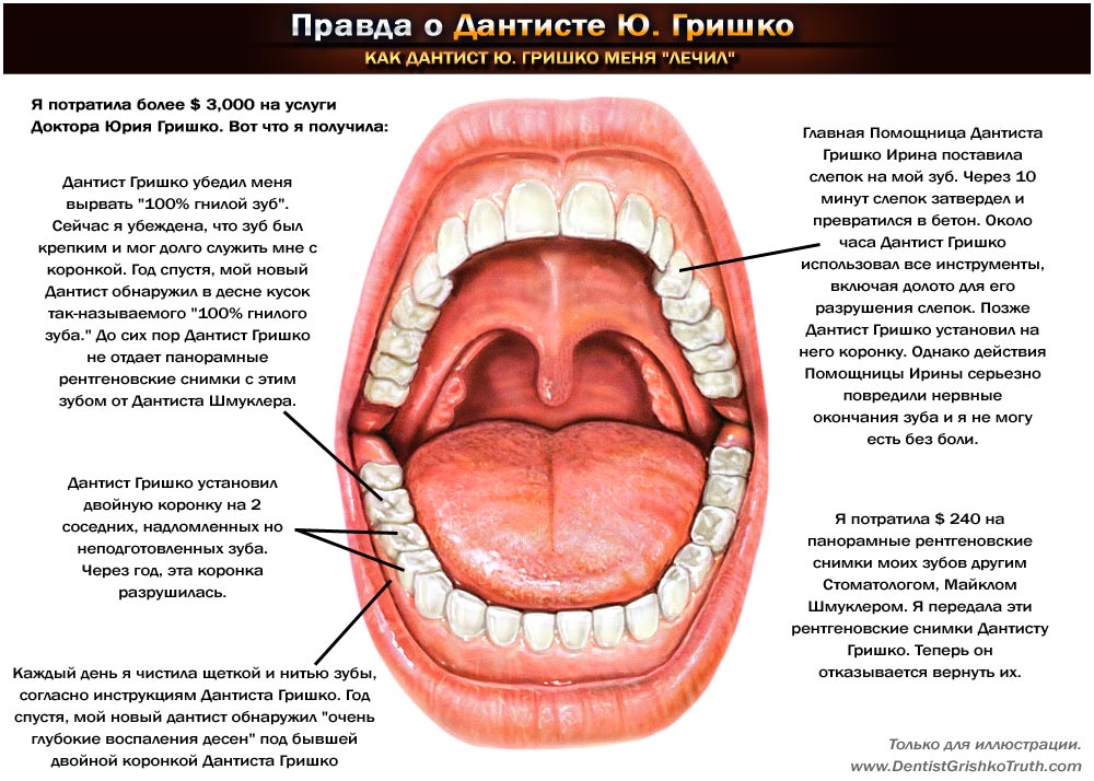 (Ротовая диаграмма) Мои травмы от стоматолога Гришко